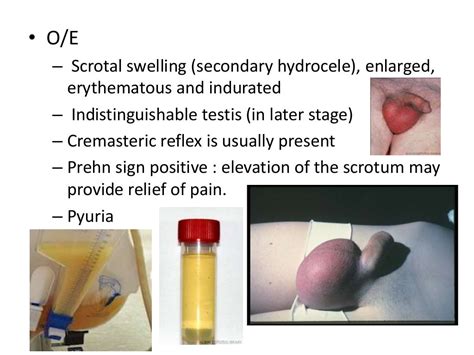 swollen scrotum without pain